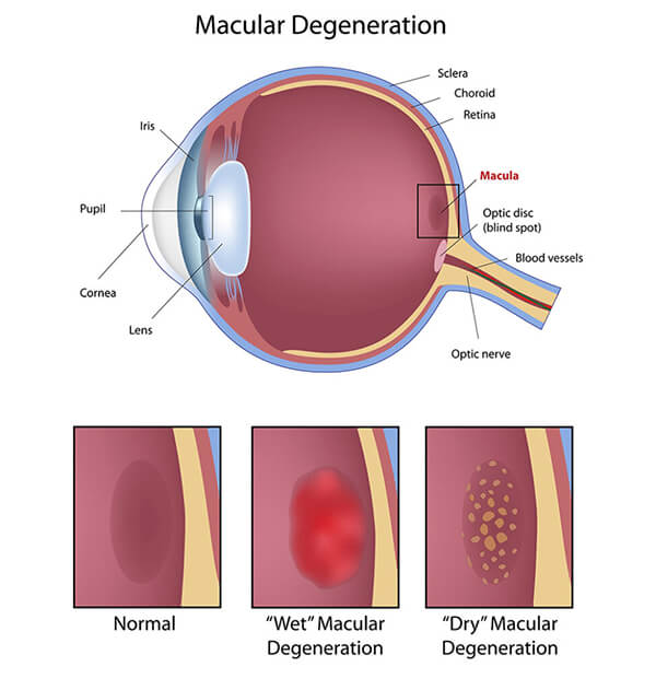 Chart Illustrating How Macular Degeneration Affects the Eye. Also shows a normal eye, one with Wet Macular Degeneration, and one with Dry Macular Degeneration