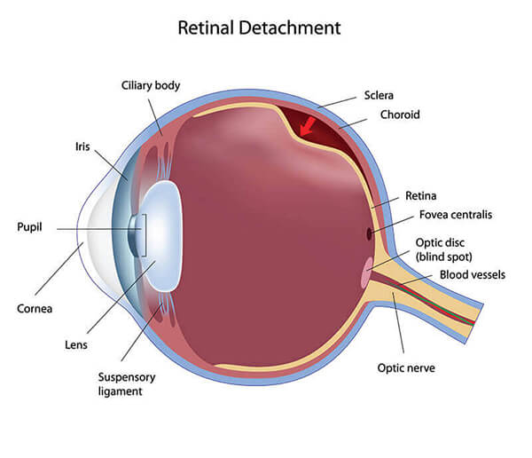 Chart Illustrating How a Retinal Detachment Affects an Eye